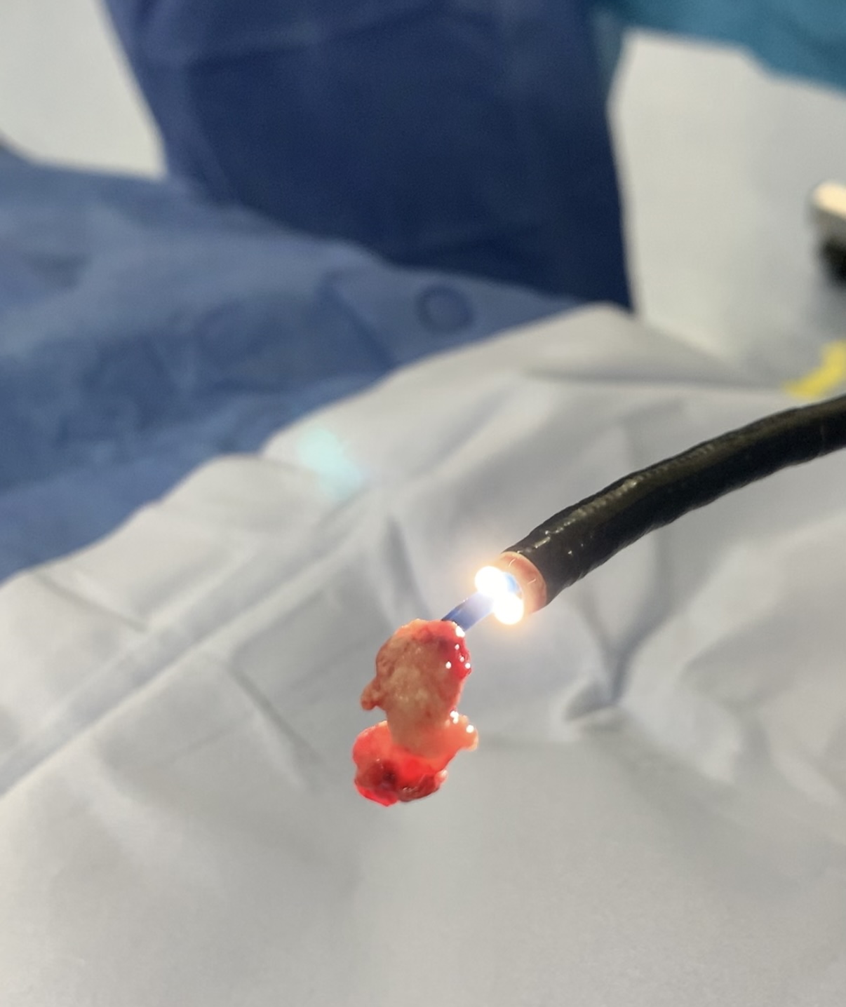 Muestra de biopsia obtenida con criosonda CryoEBUS de mayor tamaño que biopsia convencional