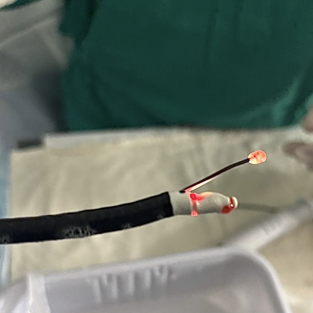 Equipo de CryoEBUS durante procedimiento diagnóstico de mediastino